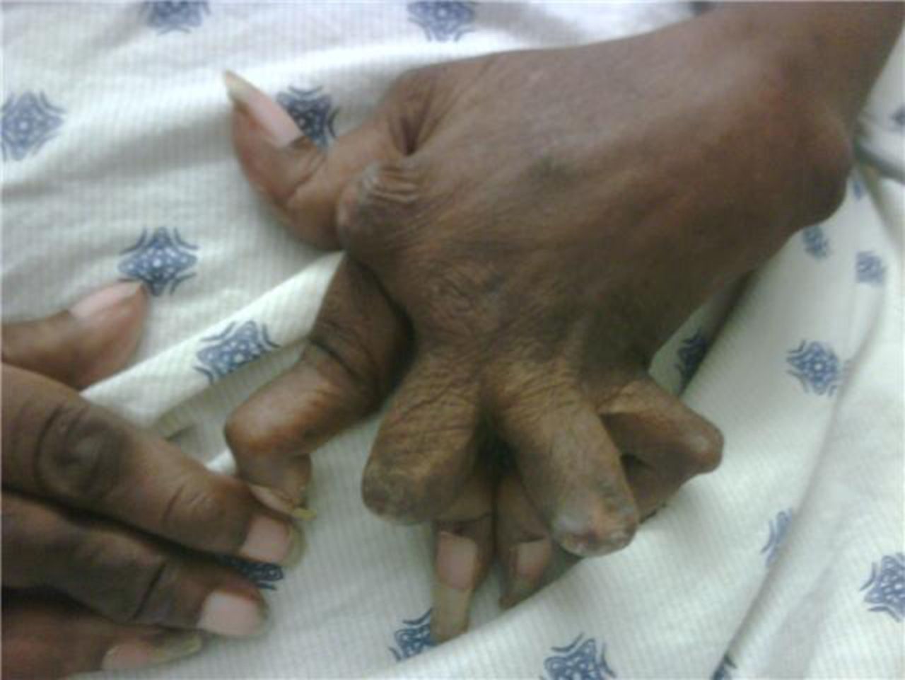 Arthritic hand deformity