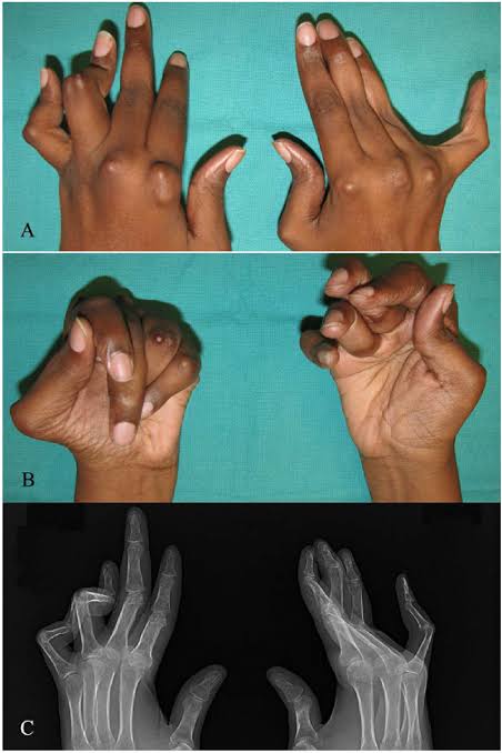 Hands affected by arthritis