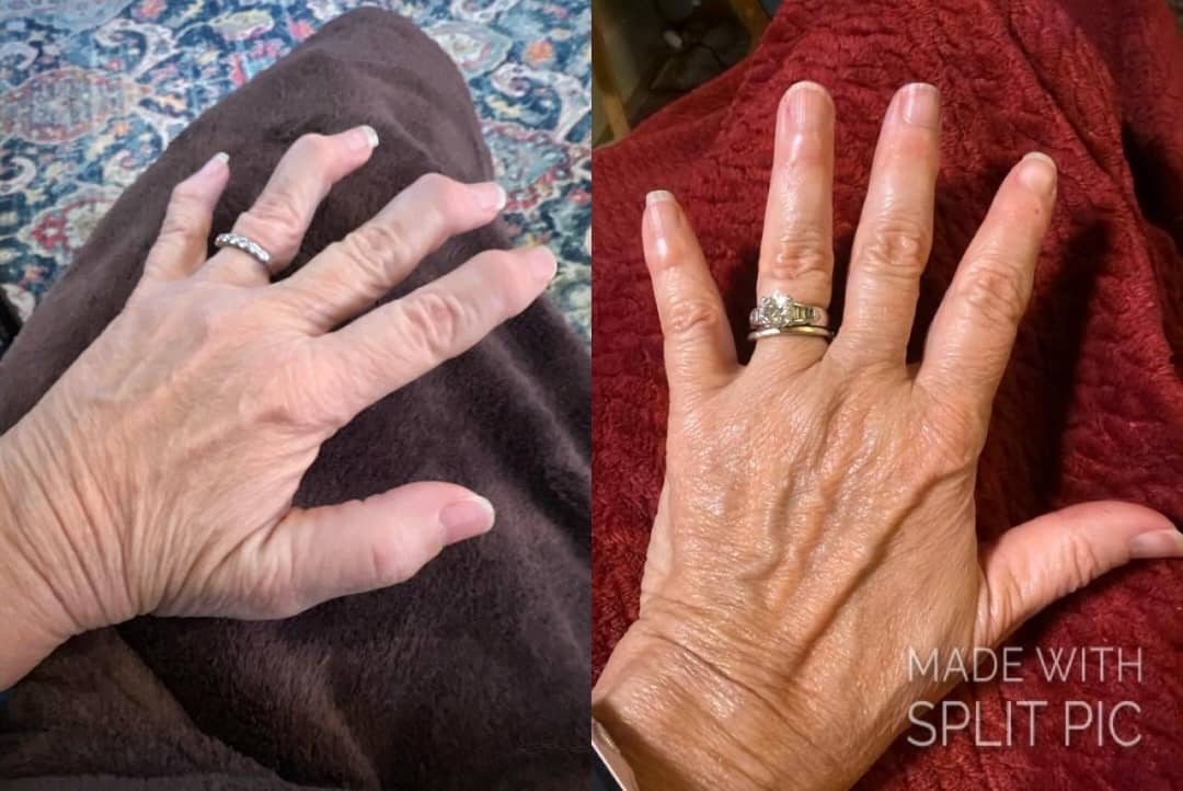 Hand recovery before and after