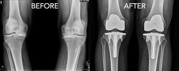 Before and after knee X-ray