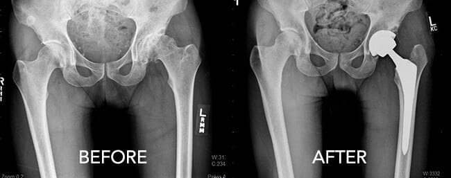 Before and after hip X-ray