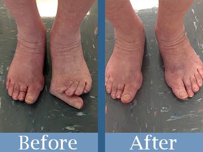 Feet improvement